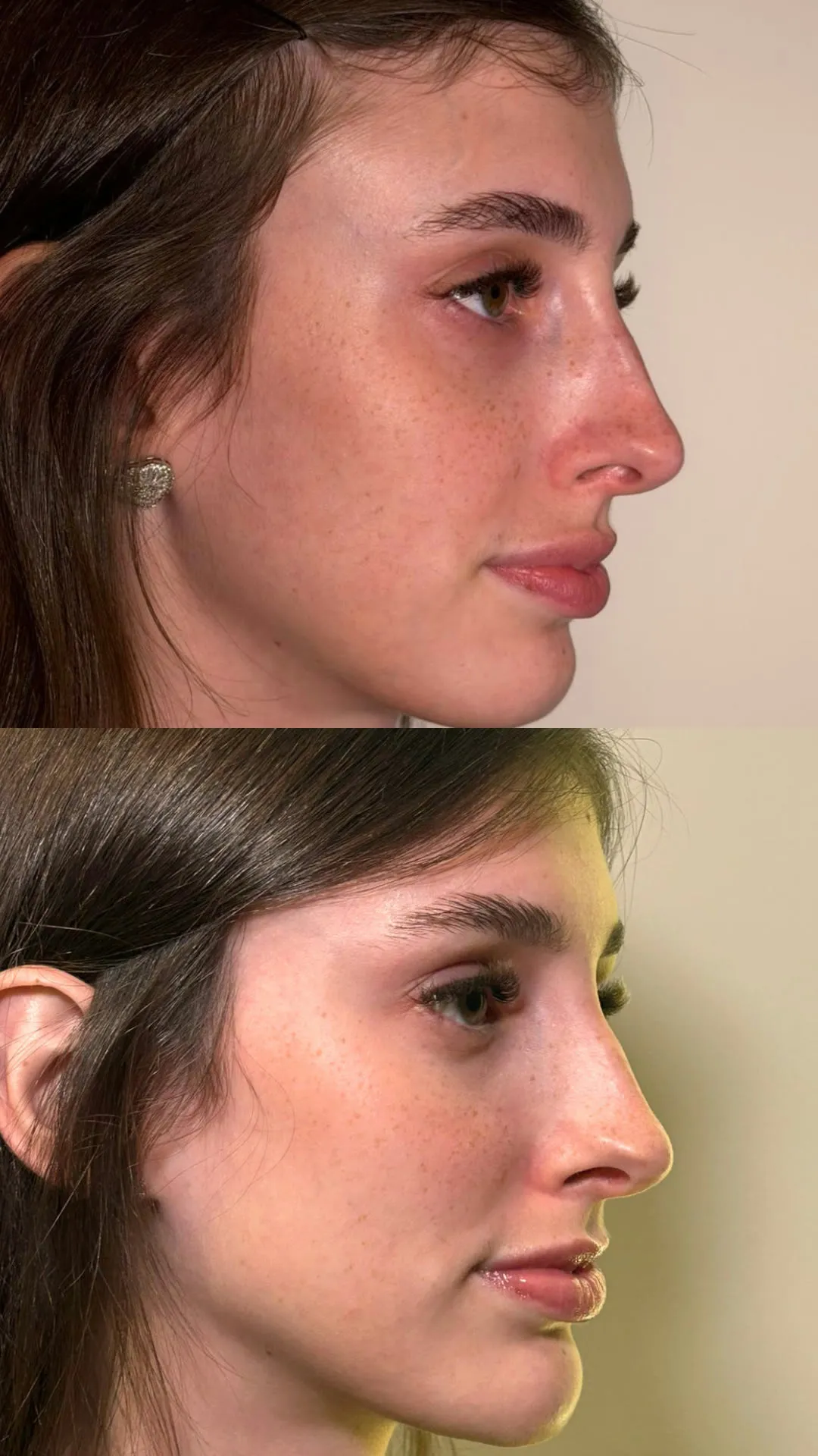 Antes e depois de rinomodelação
