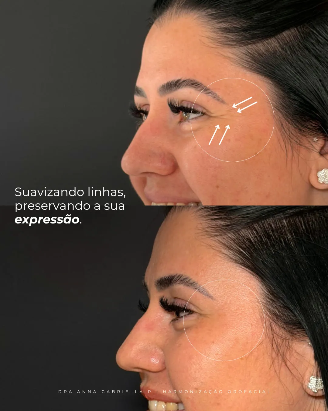 Antes e depois de suavização de linhas