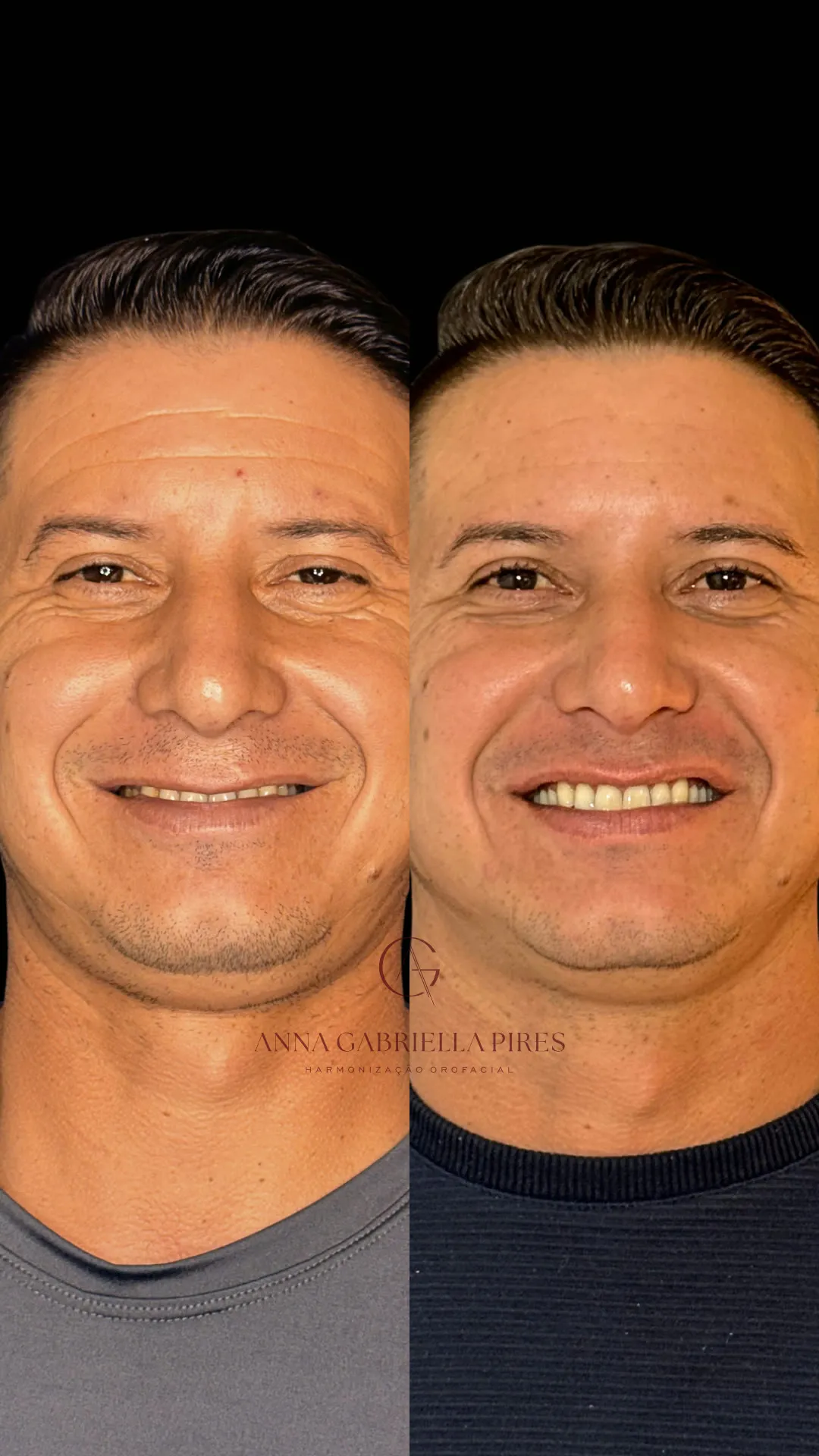 Antes e depois do sorriso