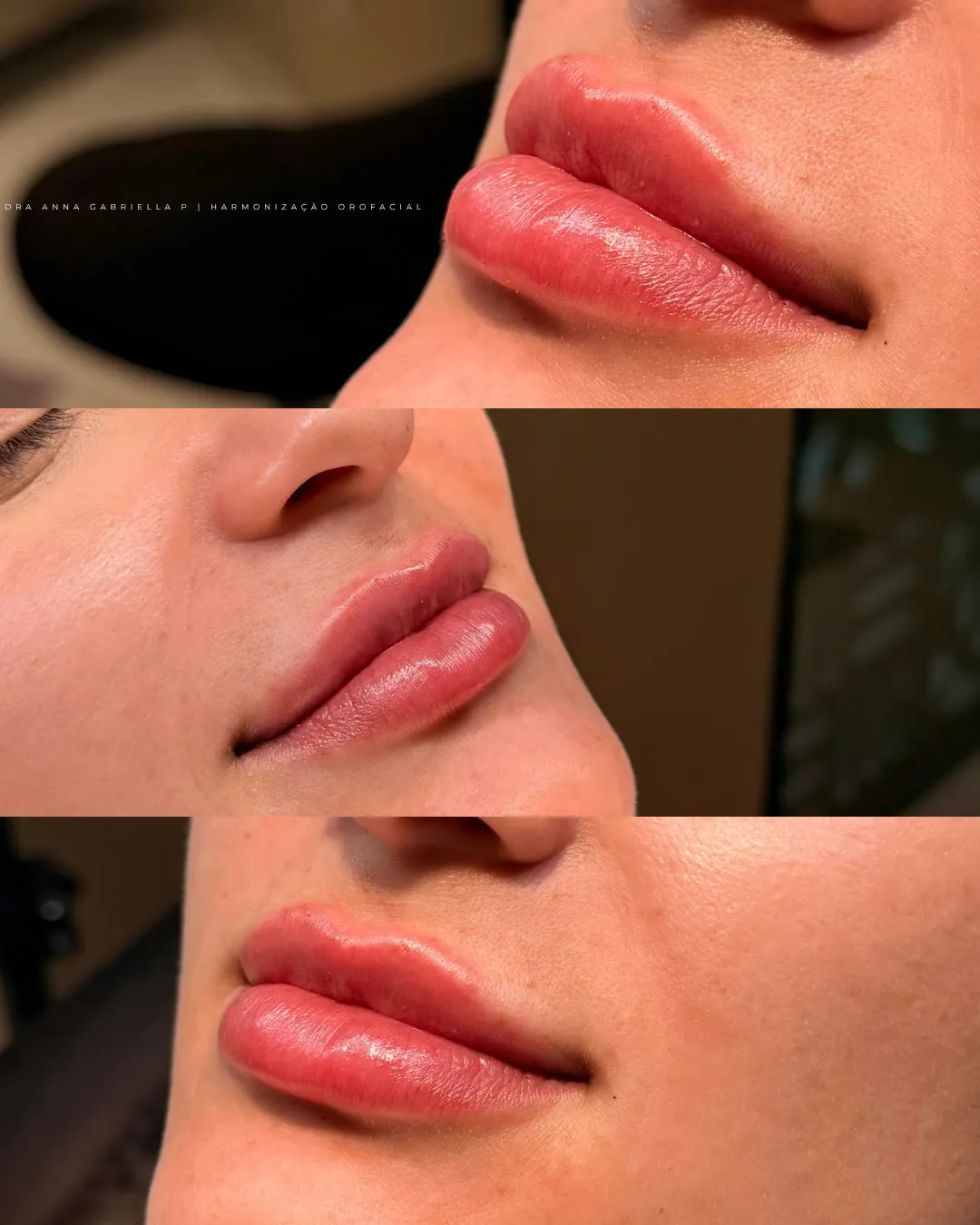 Antes e depois de preenchimento labial